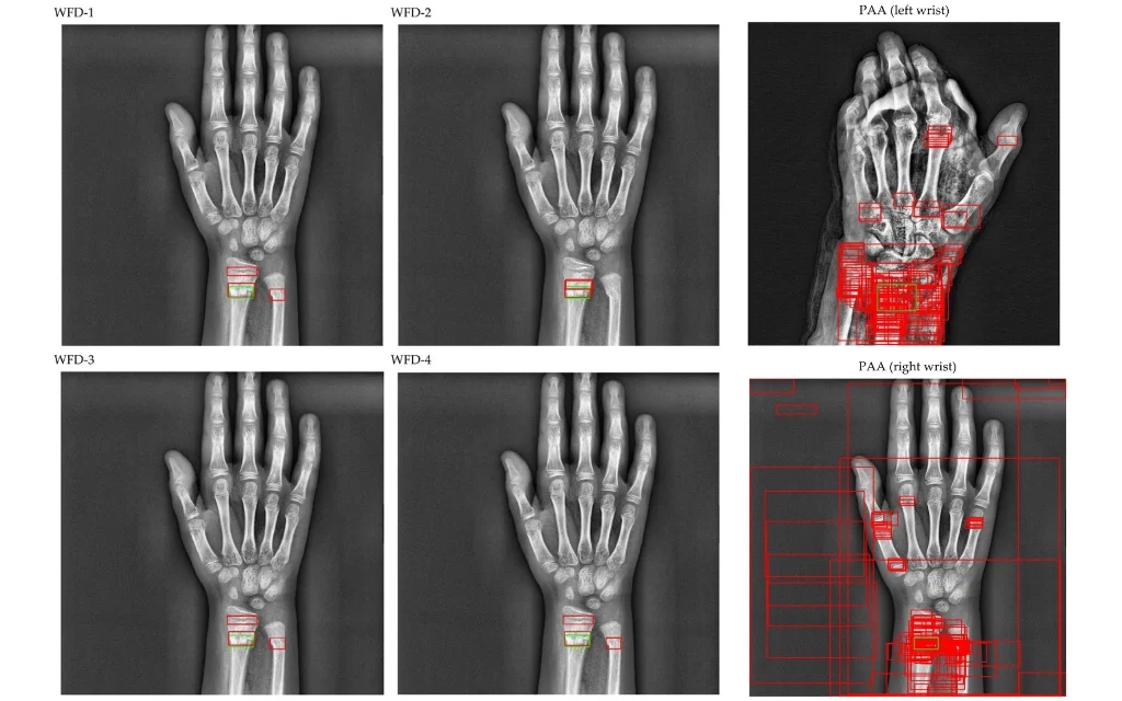 Hand X-Ray Data Collection and Analysis