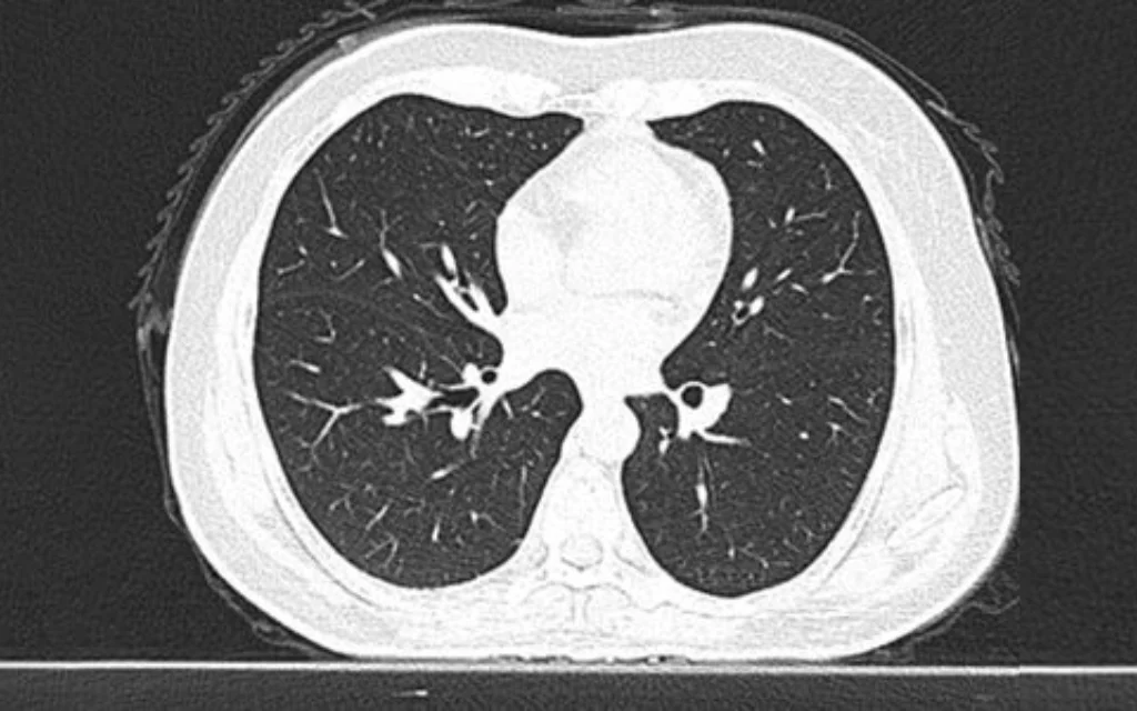 COVID-19 CT scan image classification using DL